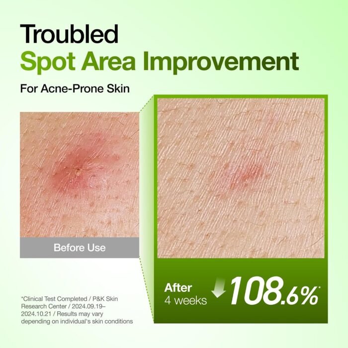 ⁦Anua Azelaic Acid 10 Hyaluron Redness Soothing Serum, Facial Serum for Sensitive skin, Hyaluronic Acid, Niacinamide, Spot Care, Natural Color, Vegan, Korean Skincare (30ml/ 1.01 fl oz.)⁩ - الصورة ⁦5⁩